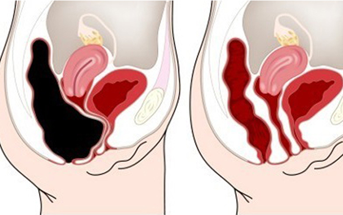 Thải sạch độc tố trong ruột nhờ ấn đúng điểm này trên bụng