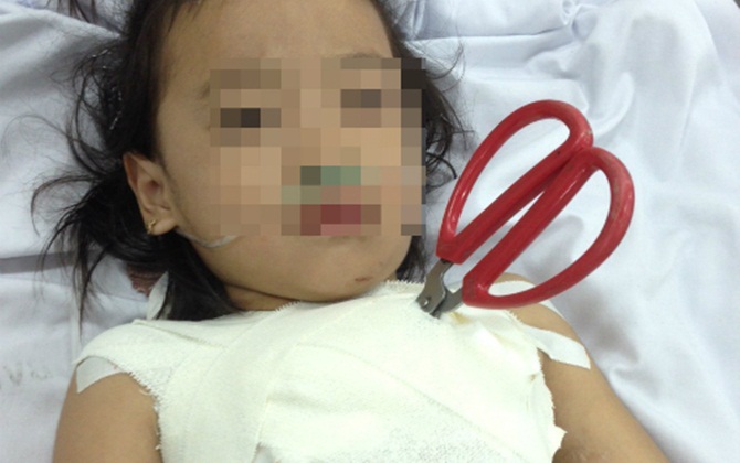 Bé 5 tuổi bị kéo đâm thủng ngực

