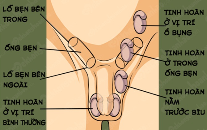 Bệnh ẩn tinh hoàn có thể gây vô sinh, ung thư cho bé trai