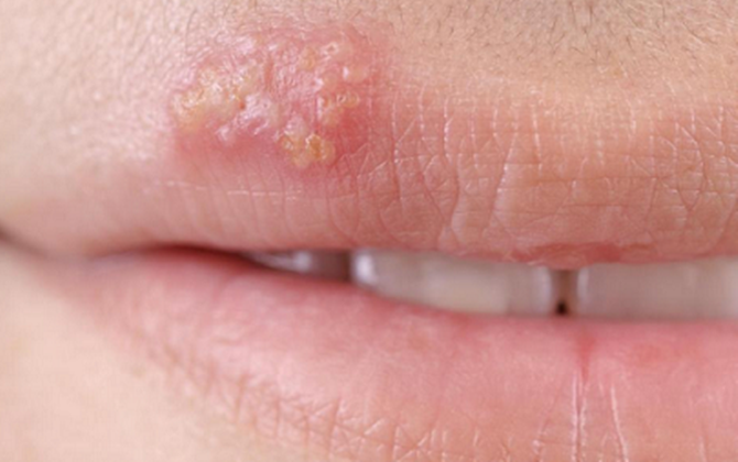 Bệnh do virut Herpes, dùng thuốc gì?
