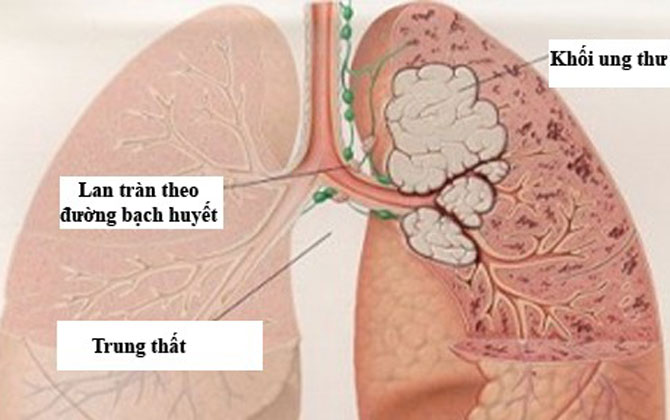 Vì sao nhiều người Việt không hút thuốc vẫn ung thư phổi?