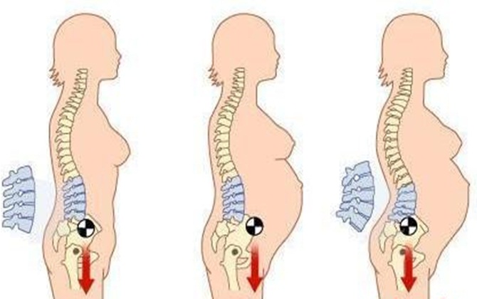 Đẻ xong mà không làm thế này thì dễ cả đời đau lưng!
