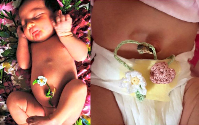 Dây buộc rốn handmade có thể khiến bé nhiễm trùng