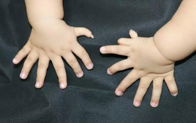 Bé trai 8 tháng tuổi mọc 15 ngón tay, 16 ngón chân