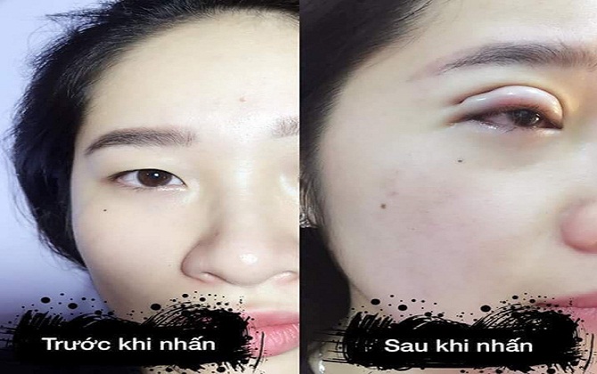 Nhấn mí xong bị sưng như... đắp bì lợn lên mắt