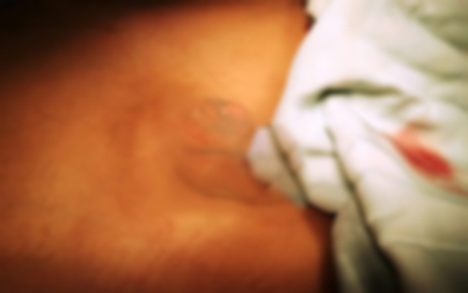 Nối lại dương vật bị đứt cho bé trai 8 tuổi