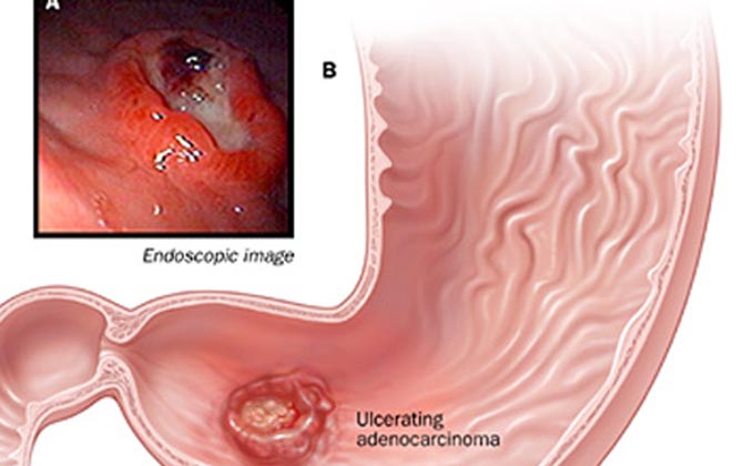 Người trẻ dễ mắc ung thư dạ dày do đâu?