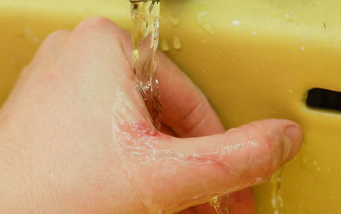 Tử vong vì những... vết xước nhỏ có thể gặp hàng ngày