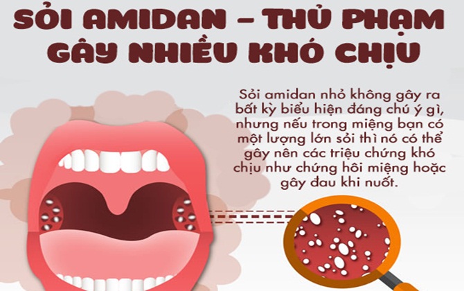 Ngoài thận, bạn có biết rằng mình cũng có thể có sỏi trong amidan không?