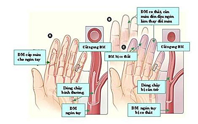 Chân tay lạnh, báo hiệu điều gì?