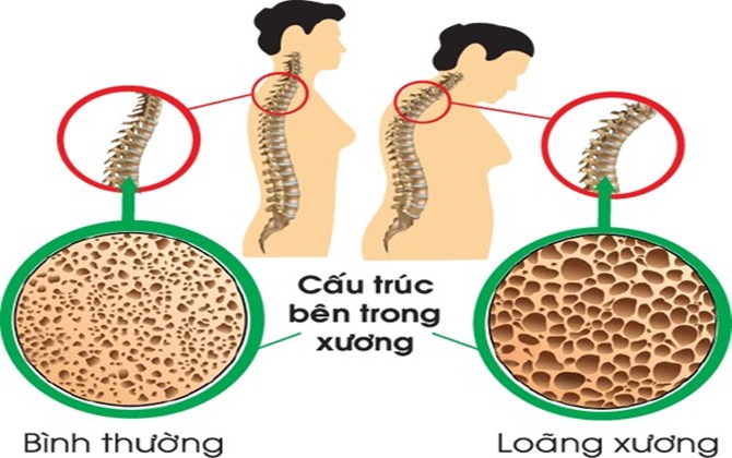 Nước uống không an toàn có thể dẫn đến loãng xương