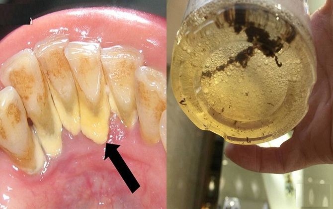 Cao răng, mảng bám, hôi miệng kinh niên cũng hết nếu ngậm thứ này mỗi tối