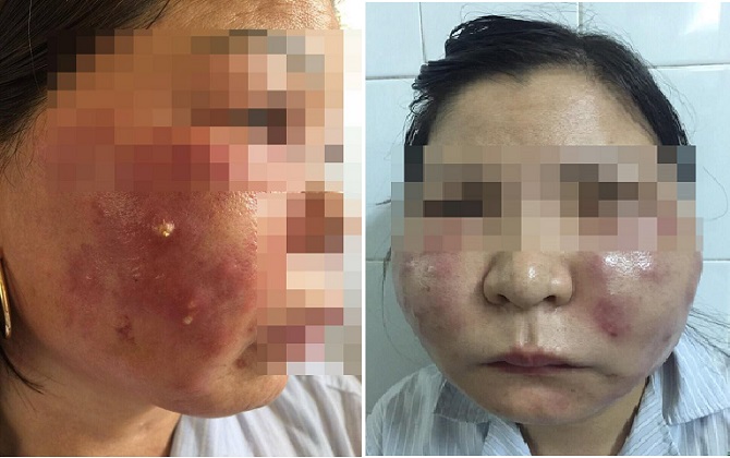 Hai mẹ con nhập viện vì tiêm thuốc làm trắng da
