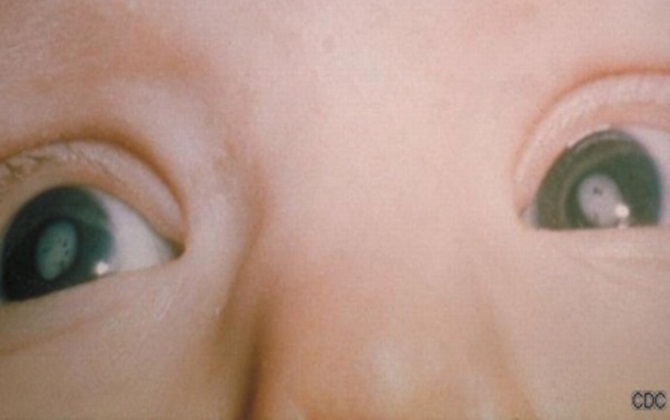 Phòng tránh nhiễm khuẩn thai nhi mẹ bầu nào cũng phải biết

