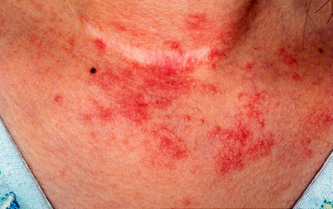 6 điều mà bệnh eczema đang cố gắng tiết lộ cho bạn