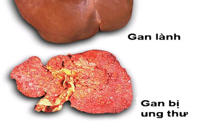 Có hay không chuyện cả gia đình mắc ung thư gan"?