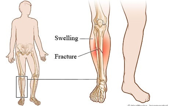 Phân biệt nạn nhân gãy xương và trật khớp