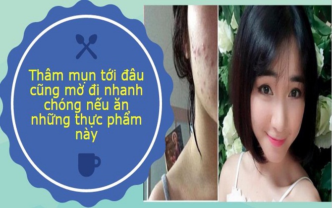 Vết thâm mụn nhiều tới đâu cùng mờ đi nhanh chóng nếu ăn những thực phẩm này