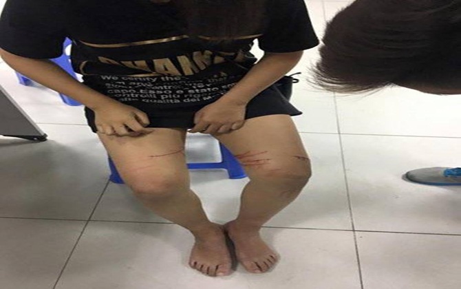 Xôn xao nữ sinh bị rạch đùi, công an đang vào cuộc điều tra