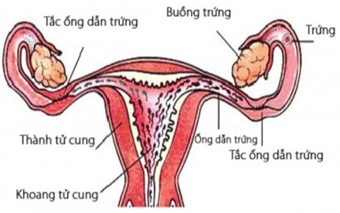 Những dấu hiệu của bệnh tắc vòi trứng khiến chị em khó có con