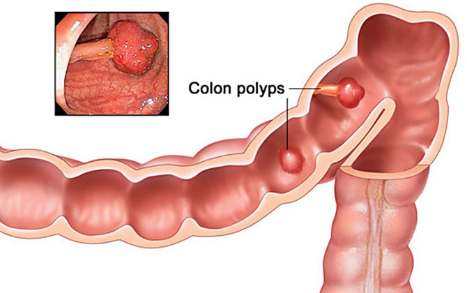 Phòng ung thư đại trực tràng: Trên 40 tuổi phải làm gì?
