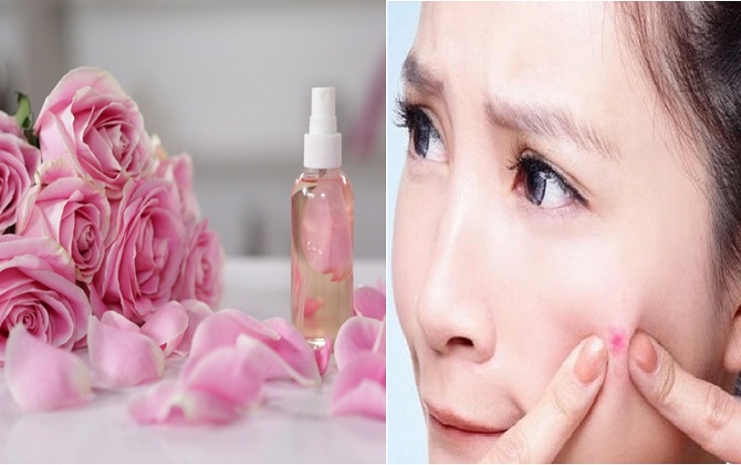 Lạnh đến đâu cũng không bỏ qua bước dùng toner để xóa tan mụn