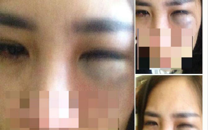 Phẫn nộ mùng 6 Tết, vợ trẻ bị chồng đánh tím mặt mày chỉ vì không đồng ý cho vợ con về ngoại