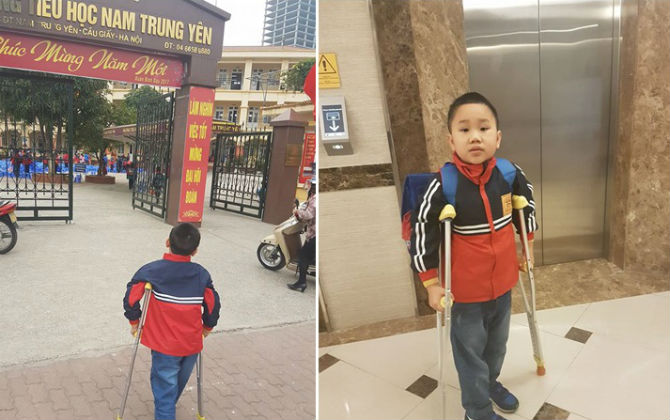 Vụ tai nạn gãy chân ở trường Nam Trung Yên: Học sinh bị thương tật 32%