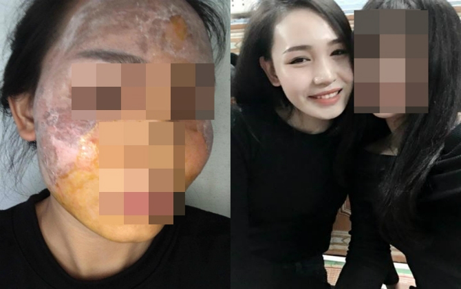 Lột trắng da chọn nhầm sản phẩm lởm, cô gái thiên nga bỗng hóa ngáo ộp