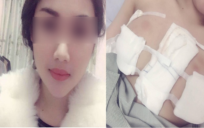 Hot girl xuýt mất mạng vì tiêm silicon nâng ngực không rõ nguồn gốc
