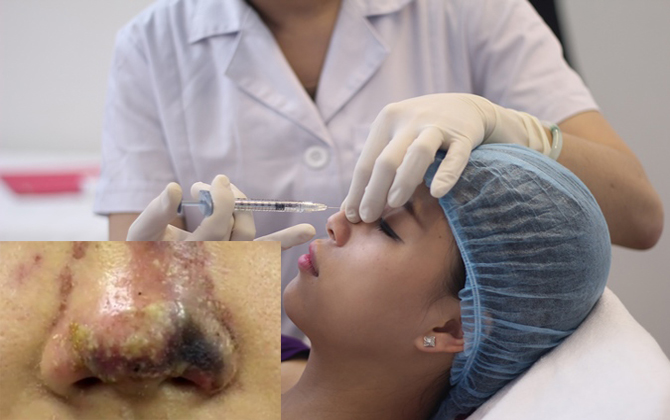 Thiếu nữ 17 hoại tử mũi vì nâng ở spa