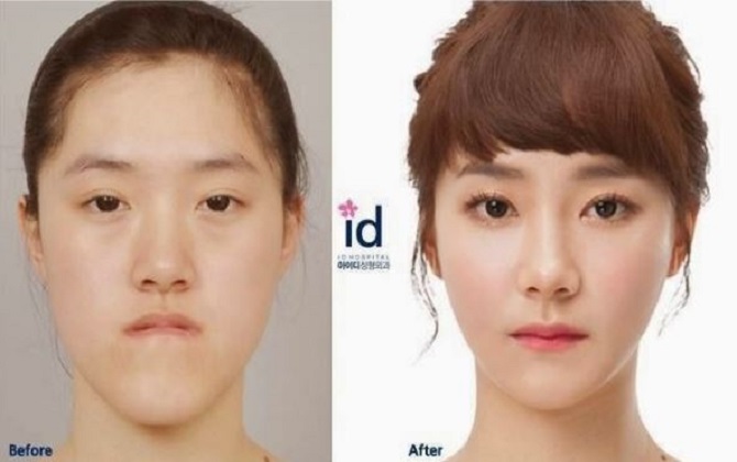 Những quốc gia có số lượng ca "dao kéo" khủng nhất trên thế giới