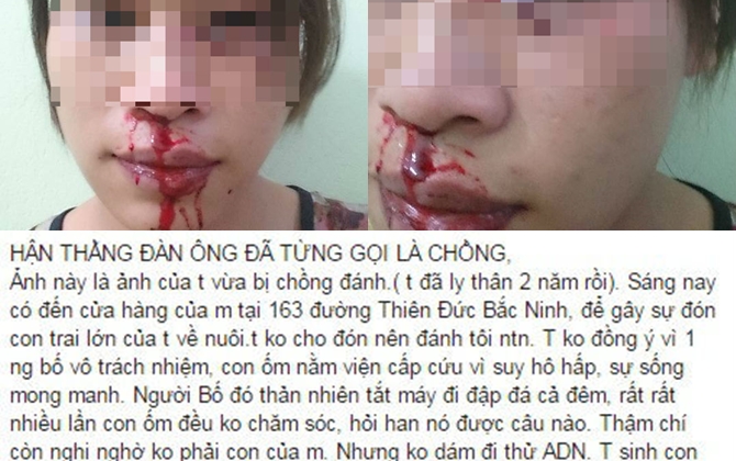 Không đồng ý cho chồng đón con, người vợ 2 con bị chồng vũ phu đánh tím mắt và chảy máu mũi