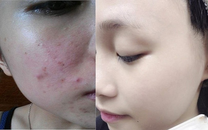 Nặn mụn xong không lo vết thâm, lỗ chân lông to, da lại căng mịn trắng sáng nhờ làm điều này