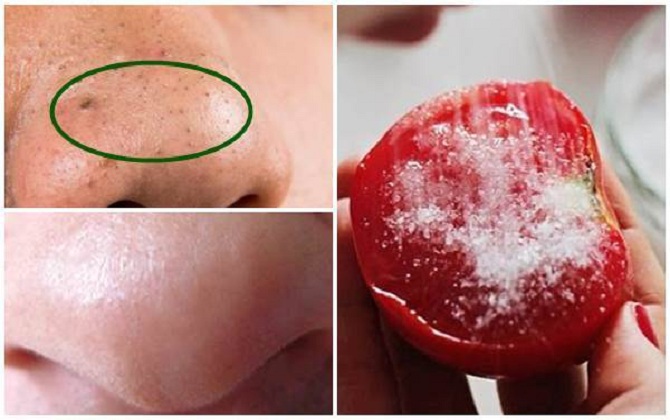 Chấm nửa quả cà chua vào thứ này rồi chà lên mũi, mụn đầu đen chi chít cũng bật ra hết sạch sau 1 lần duy nhất