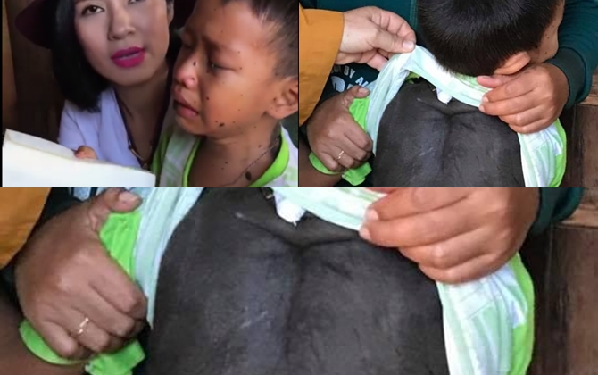 Mẹ liệt nửa người, con 5 tuổi bị tim bẩm sinh và vết bớt trâu đen đúa khắp cơ thể