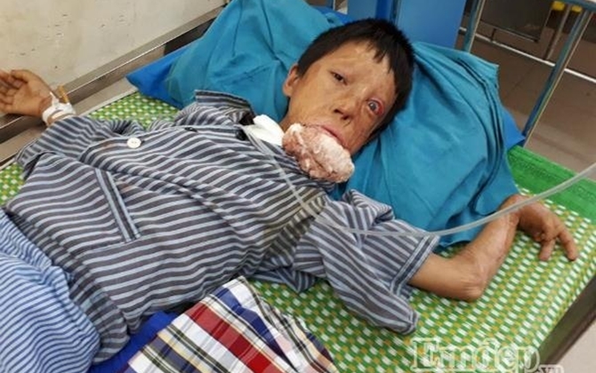 Xót lòng bé 12 tuổi được điều trị miễn phí, nhưng bố mẹ vẫn không có tiền mua cơm nuôi con trong viện
