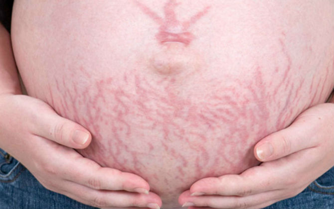 Không muốn bị rạn bụng, mẹ bầu hãy nhớ làm 3 việc này!