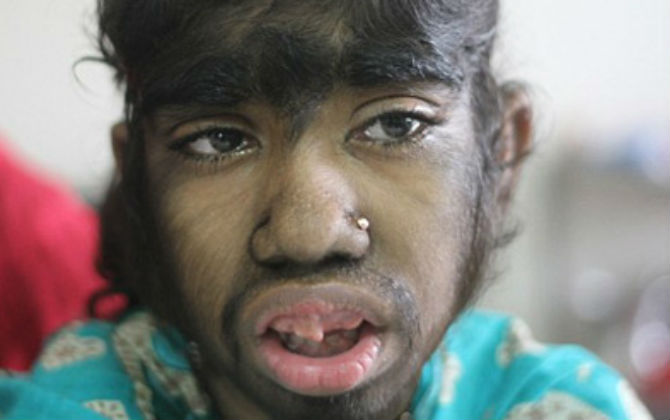 Những người khổ sở với căn bệnh 1 tỷ người mới có 1 người mắc