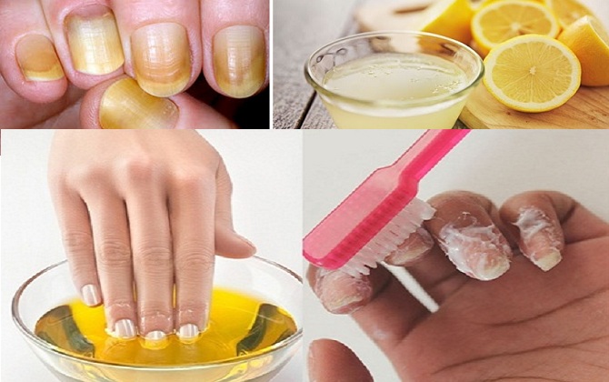 Làm nail quá nhiều khiến móng tay vàng khè, dễ gãy hãy làm ngay 4 mẹo sau để cấp cứu