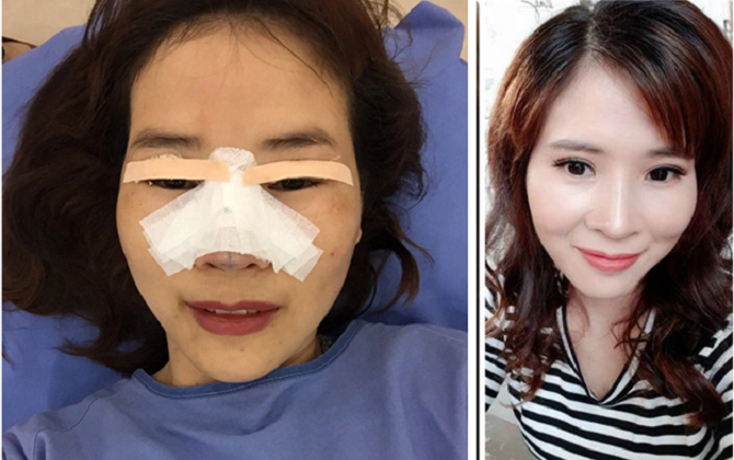 Hành trình dao kéo lột xác từ 'quạ hóa công' chỉ tốn 25 triệu đồng của bà mẹ 3 con