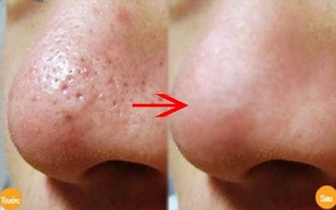 Lỗ chân lông to đến mấy cũng phải “thu mình” nhỏ lại chỉ nhờ 1 mớ rau răm