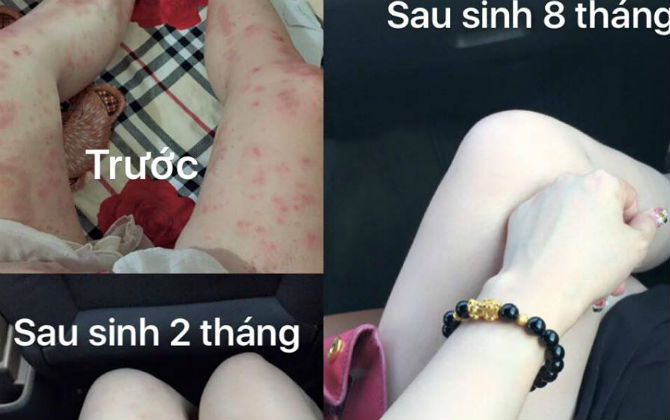 Bà mẹ trẻ 9x mách chị em cách 'đánh bay' ngứa, vết thâm trên da bằng 2 nguyên liệu cực dễ tìm