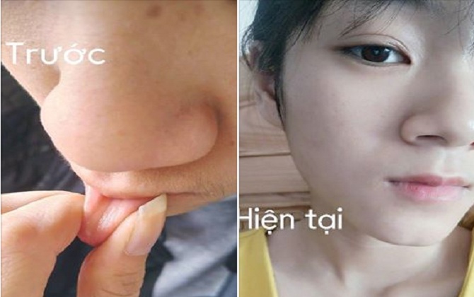 Chẳng tốn tiền đi triệt, tôi đã tẩy ria mép sạch bay, lâu mọc lại đơn giản tại nhà