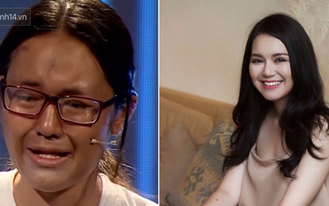 Nữ sinh từng bị gọi là "dị nhân" và khi lột xác nhờ PTTM: 19 năm đau khổ, chỉ ước được sống như người bình thường!