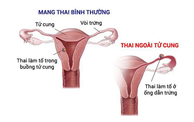 Đây chính là những nguyên nhân khiến mẹ mang thai ngoài tử cung, tìm hiểu ngay để tránh