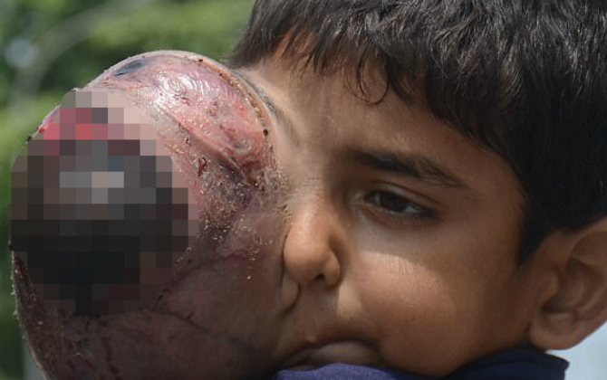 Mắt lồi ra, nhiễm trùng đáng sợ, những đứa trẻ không nhìn được mọi thứ vì căn bệnh nguy hiểm này