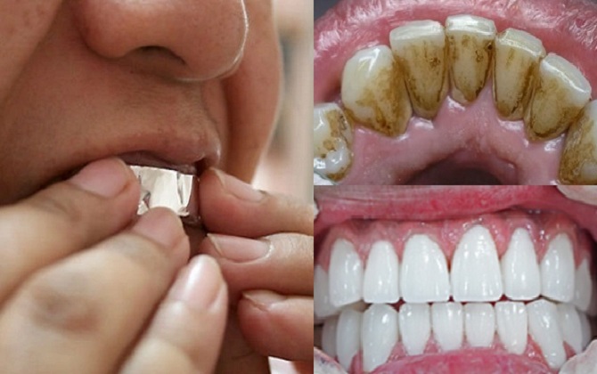 Bọc răng với giấy bạc và nguyên liệu này trong 1 tiếng, răng vàng đến mấy cũng sáng bóng như tẩy trắng