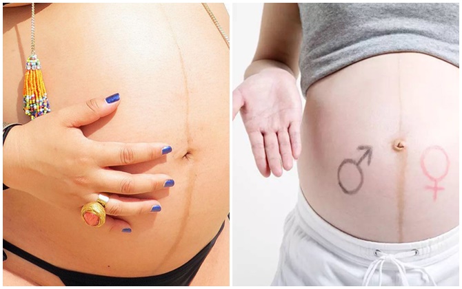 Đường sọc nâu giữa bụng mẹ bầu tiết lộ điều gì?