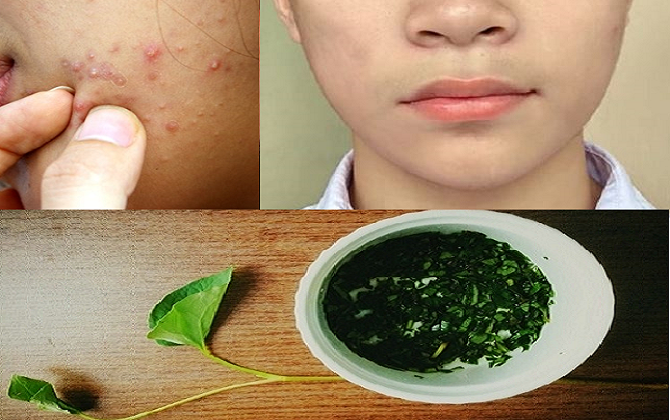 Chỉ 1 tháng đắp mặt với loại rau chưa tới 2.000 này, chàng trai 10x đã đánh bay 'sạch sành sanh' mụn trứng cá